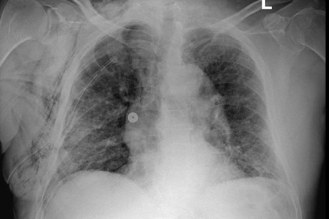 צילום הריאות של פנינה בירמן בר