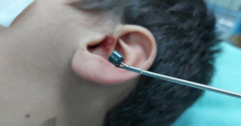 החרוז שחולץ מאוזנו של הילד. צילום באדיבות בית החולים מאיר
